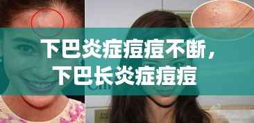 下巴炎症痘痘不断,下巴长炎症痘痘