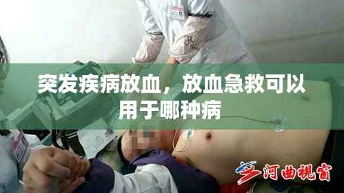 突发疾病放血,放血急救可以用于哪种病