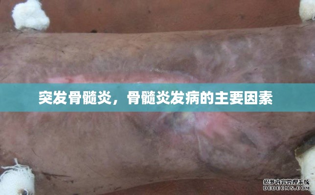 突发骨髓炎,骨髓炎发病的主要因素